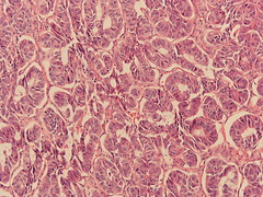 Malignant granulosa cell tumor of the ovary with heterogenous differentiation